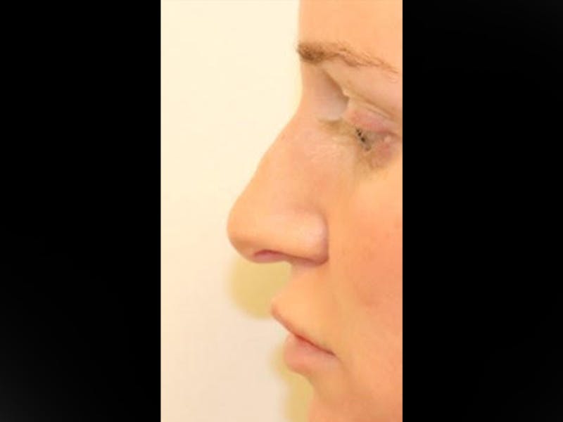 Rhinoplasty/Nose Reshaping Before & After Gallery - Patient 87551646 - Image 5