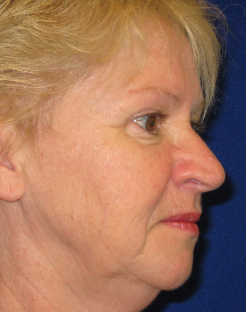 Necklift Before & After Gallery - Patient 87551629 - Image 5
