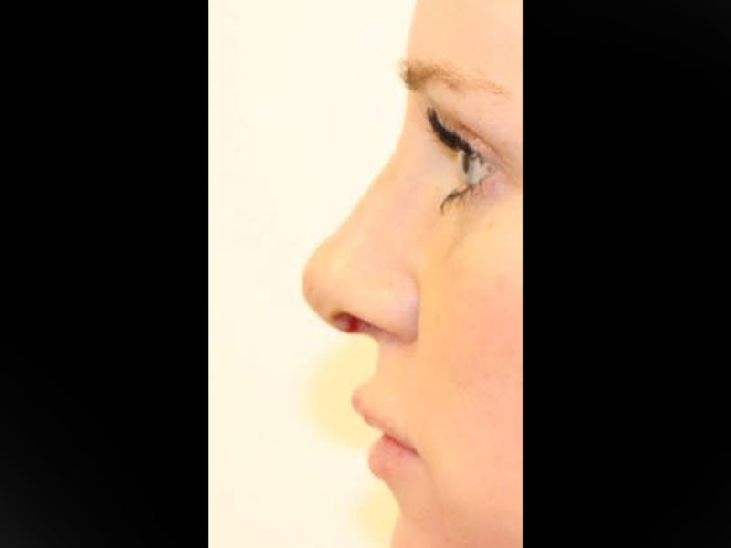 Rhinoplasty/Nose Reshaping Before & After Gallery - Patient 87551646 - Image 6