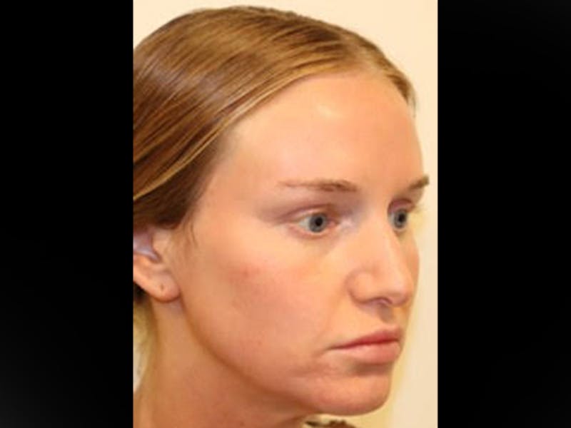 Rhinoplasty/Nose Reshaping Before & After Gallery - Patient 87551646 - Image 7