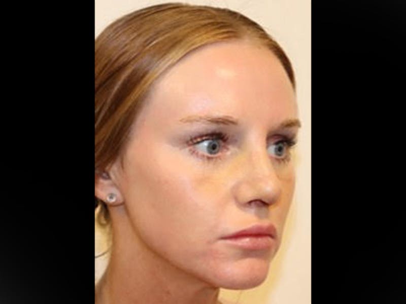 Rhinoplasty/Nose Reshaping Before & After Gallery - Patient 87551646 - Image 8