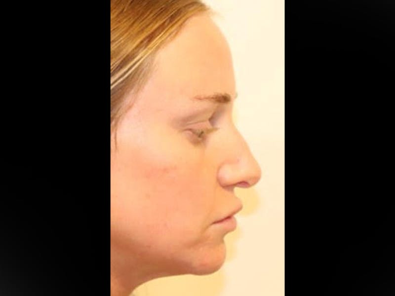 Rhinoplasty/Nose Reshaping Before & After Gallery - Patient 87551646 - Image 9