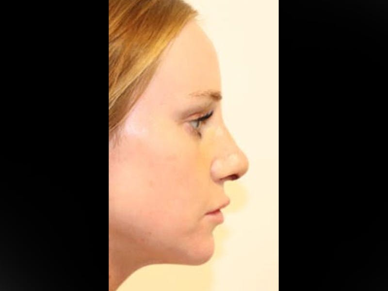 Rhinoplasty/Nose Reshaping Before & After Gallery - Patient 87551646 - Image 10