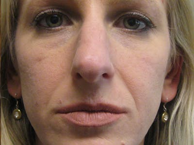 Rhinoplasty/Nose Reshaping Before & After Gallery - Patient 87551676 - Image 1