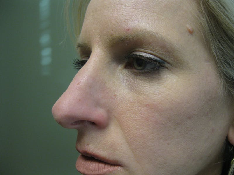 Rhinoplasty/Nose Reshaping Before & After Gallery - Patient 87551676 - Image 3