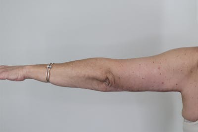Brachioplasty Before & After Gallery - Patient 87551670 - Image 2