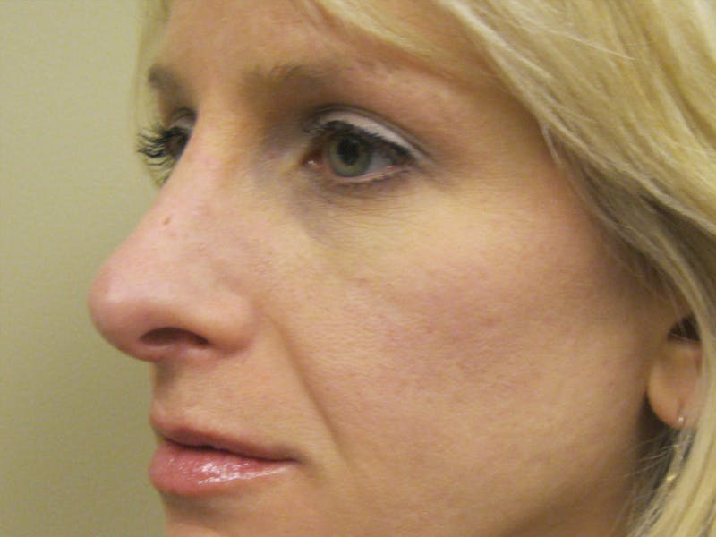 Rhinoplasty/Nose Reshaping Before & After Gallery - Patient 87551676 - Image 4
