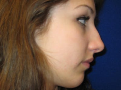 Rhinoplasty/Nose Reshaping Before & After Gallery - Patient 87551693 - Image 1