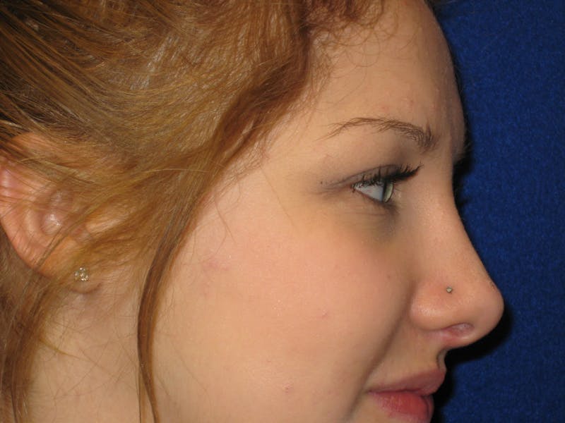Rhinoplasty/Nose Reshaping Before & After Gallery - Patient 87551693 - Image 2