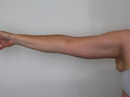 Arm Lift Maine  Best Brachioplasty Surgery in Portland Maine