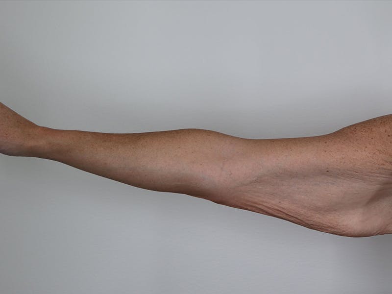 Brachioplasty Before & After Gallery - Patient 87551698 - Image 1