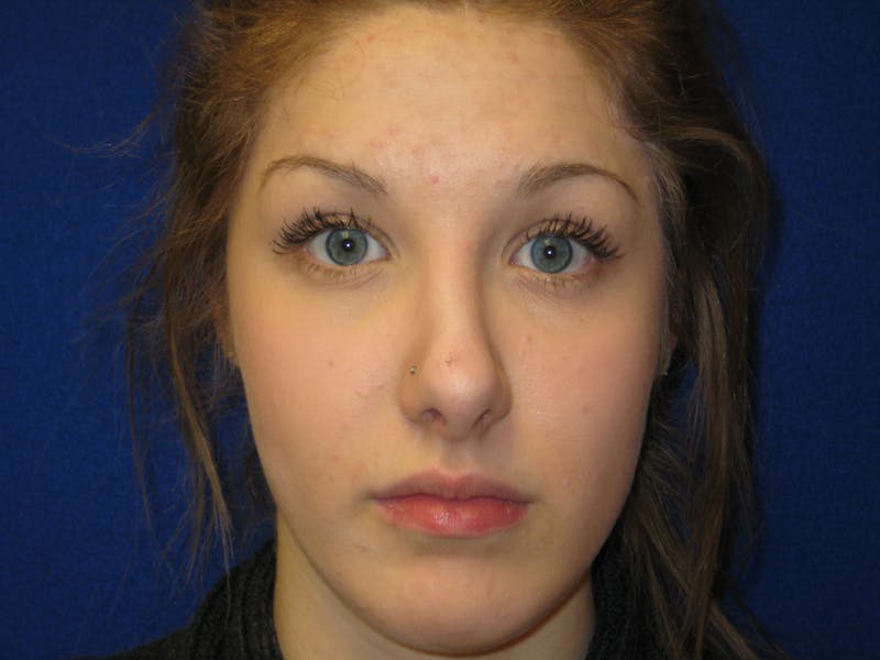 Rhinoplasty/Nose Reshaping Before & After Gallery - Patient 87551693 - Image 4