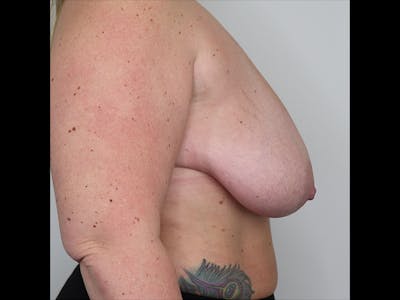 Breast Reduction Before & After Gallery - Patient 87551714 - Image 1