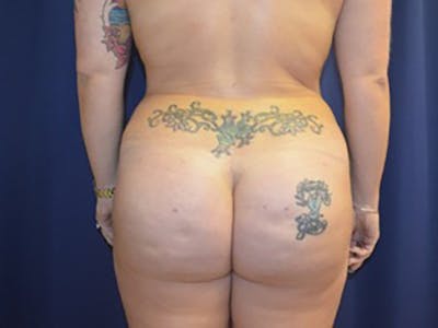 Brazilian Butt Lift Before & After Gallery - Patient 87551719 - Image 2