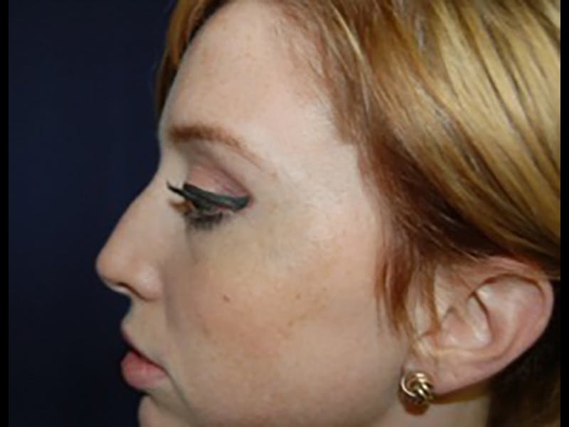 Rhinoplasty/Nose Reshaping Before & After Gallery - Patient 87551700 - Image 3