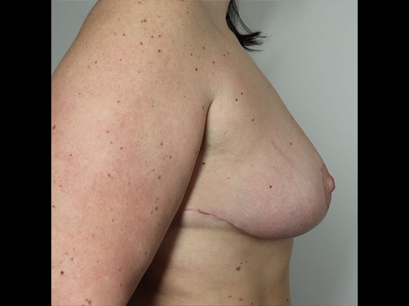 Breast Reduction Before & After Gallery - Patient 87551714 - Image 2