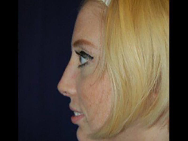 Rhinoplasty/Nose Reshaping Before & After Gallery - Patient 87551700 - Image 4