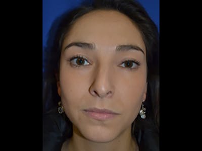 Rhinoplasty/Nose Reshaping Before & After Gallery - Patient 87551717 - Image 1