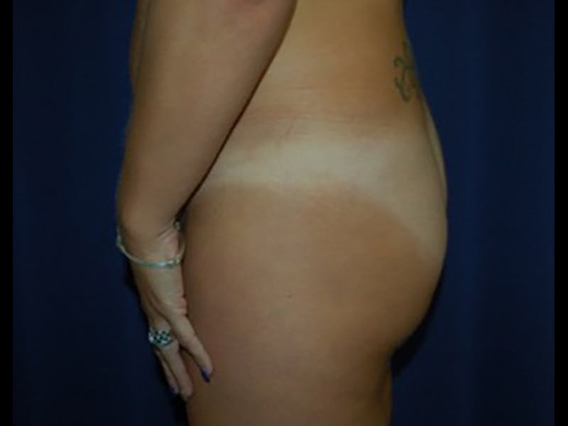 Brazilian Butt Lift Before & After Gallery - Patient 87551719 - Image 5