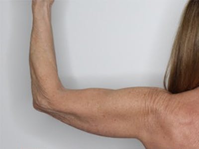 Arm Lift Before & After Gallery - Patient 87551716 - Image 1