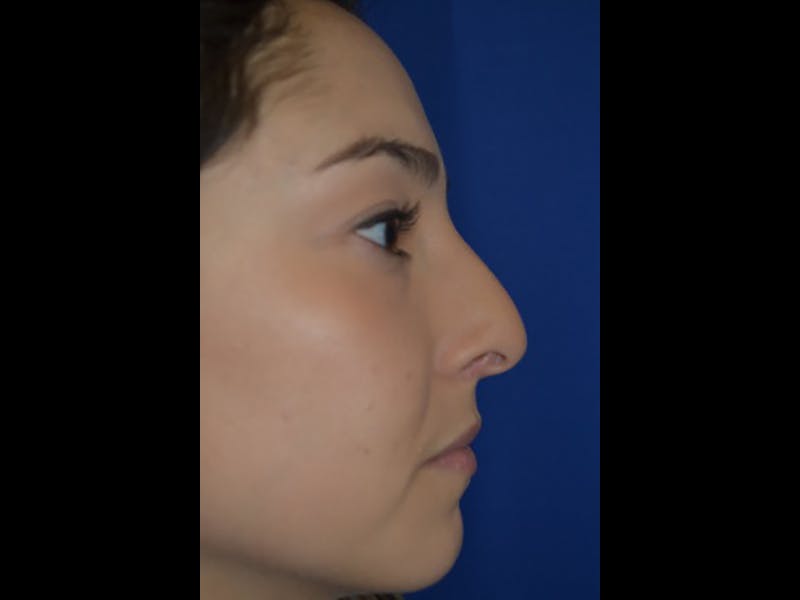 Rhinoplasty/Nose Reshaping Before & After Gallery - Patient 87551717 - Image 3