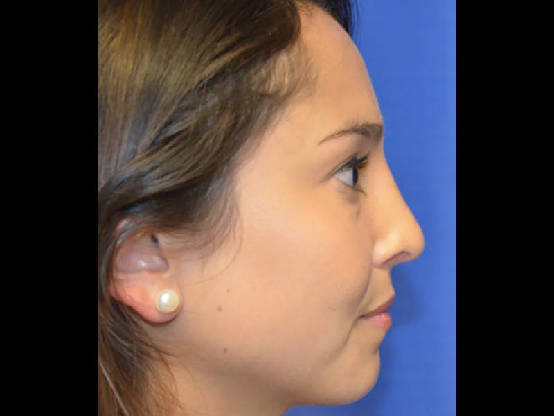 Rhinoplasty/Nose Reshaping Before & After Gallery - Patient 87551717 - Image 4