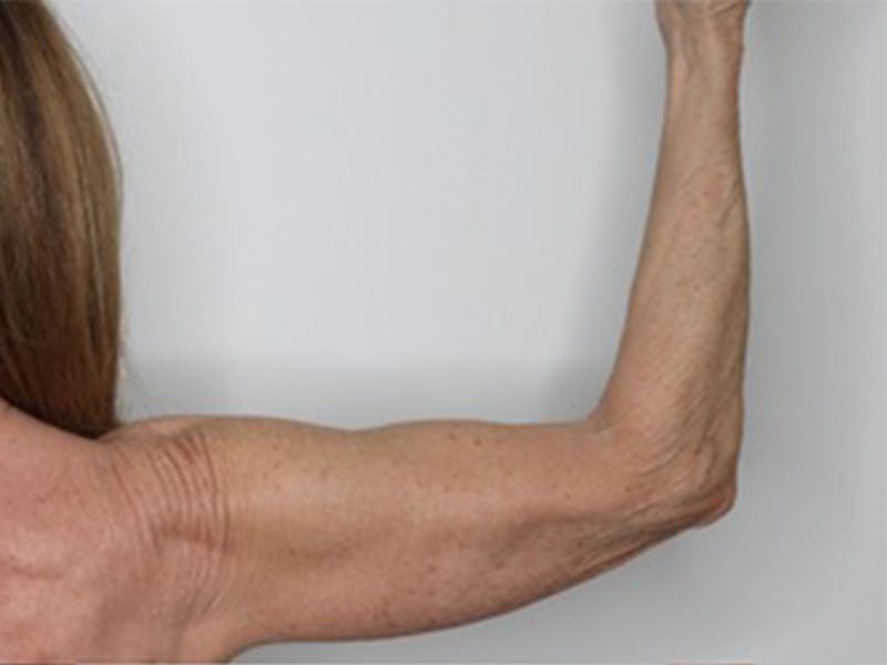 Arm Lift Before & After Gallery - Patient 87551716 - Image 3