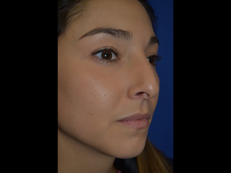 Rhinoplasty/Nose Reshaping Before & After Gallery - Patient 87551717 - Image 5