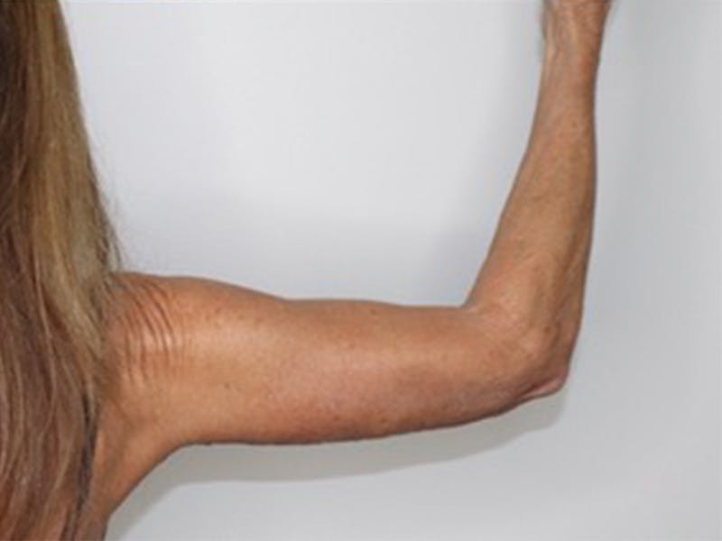 Arm Lift Before & After Gallery - Patient 87551716 - Image 4