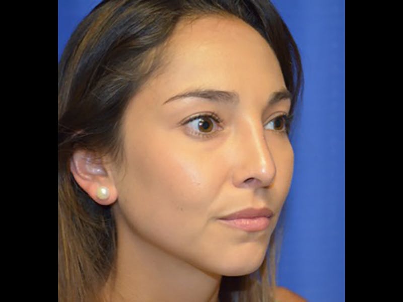 Rhinoplasty/Nose Reshaping Before & After Gallery - Patient 87551717 - Image 6