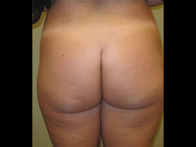 Brazilian Butt Lift Before & After Gallery - Patient 87551728 - Image 1