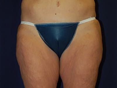 Thighplasty Before & After Gallery - Patient 87551724 - Image 1