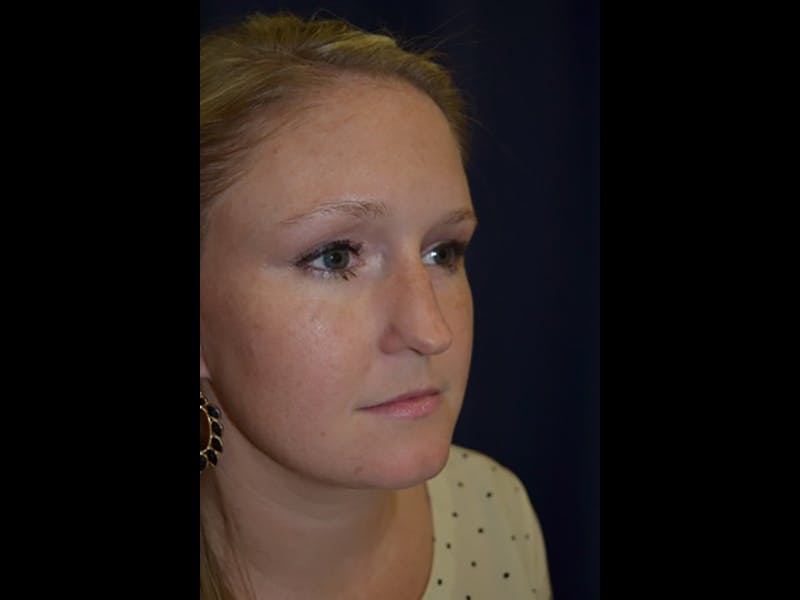 Rhinoplasty/Nose Reshaping Before & After Gallery - Patient 87551726 - Image 3