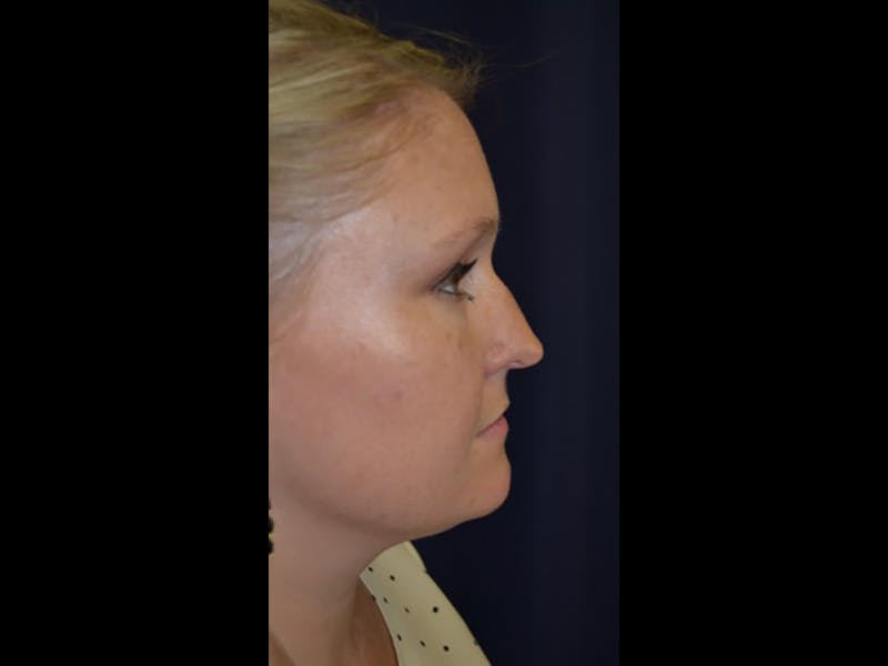 Rhinoplasty/Nose Reshaping Before & After Gallery - Patient 87551726 - Image 5