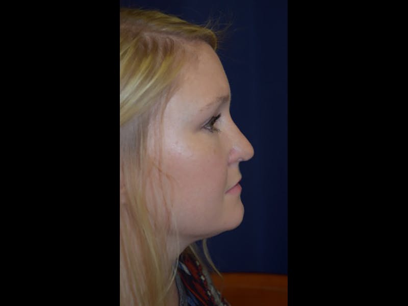 Rhinoplasty/Nose Reshaping Before & After Gallery - Patient 87551726 - Image 6