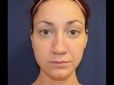 Rhinoplasty/Nose Reshaping Before & After Gallery - Patient 87551735 - Image 1