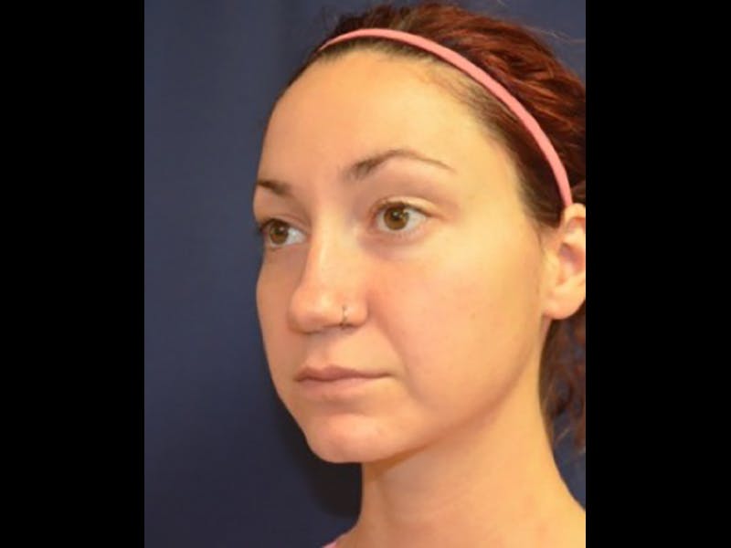 Rhinoplasty/Nose Reshaping Before & After Gallery - Patient 87551735 - Image 3
