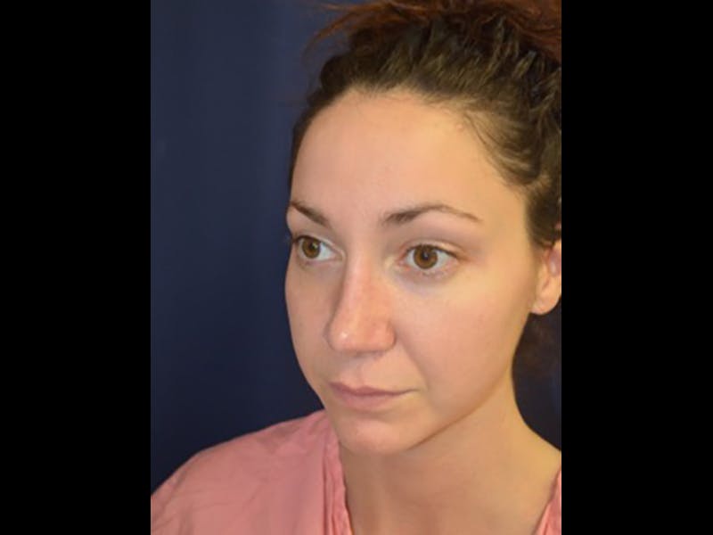 Rhinoplasty/Nose Reshaping Before & After Gallery - Patient 87551735 - Image 4