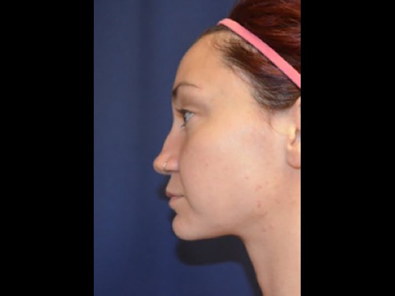 Rhinoplasty/Nose Reshaping Before & After Gallery - Patient 87551735 - Image 5