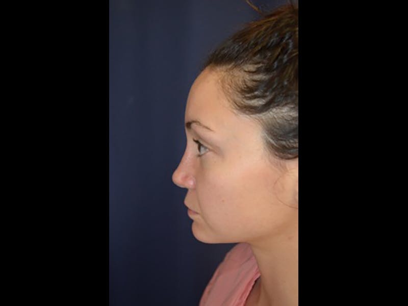Rhinoplasty/Nose Reshaping Before & After Gallery - Patient 87551735 - Image 6