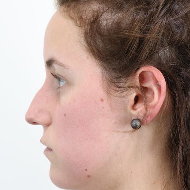 Rhinoplasty/Nose Reshaping Before & After Gallery - Patient 87551747 - Image 1