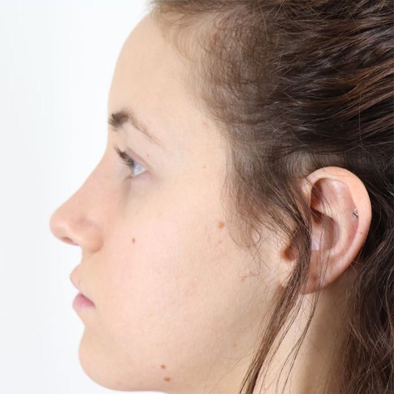 Rhinoplasty/Nose Reshaping Before & After Gallery - Patient 87551747 - Image 2