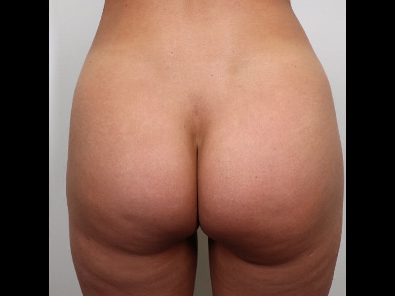 Brazilian Butt Lift Before & After Gallery - Patient 87551740 - Image 2