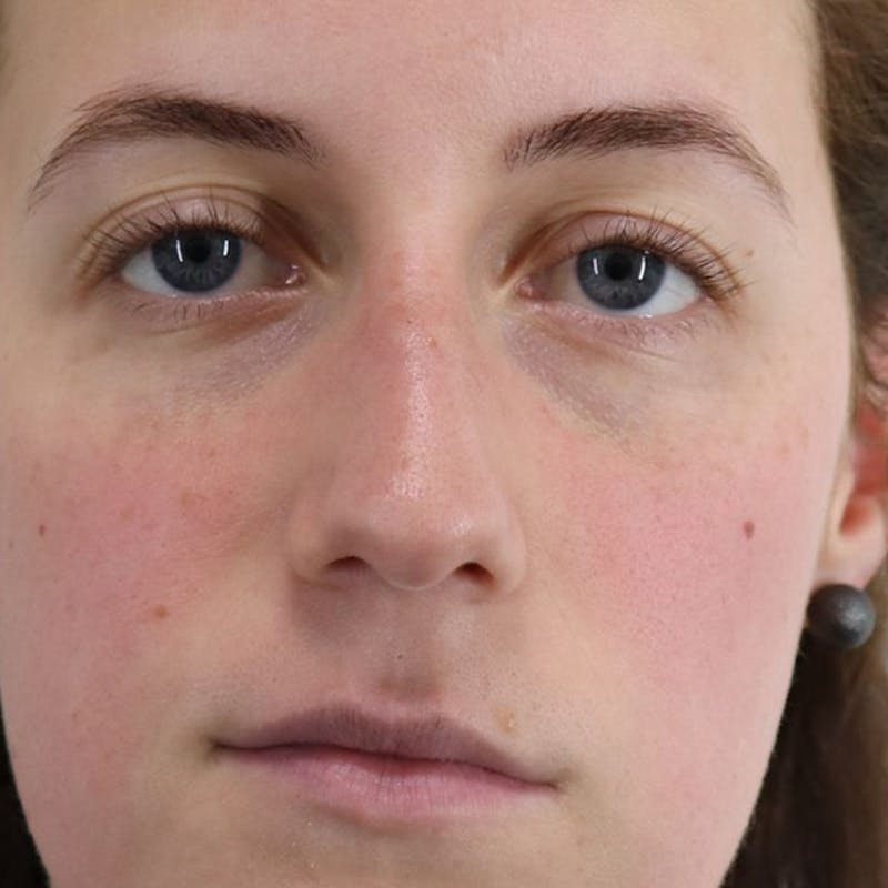 Rhinoplasty/Nose Reshaping Before & After Gallery - Patient 87551747 - Image 3