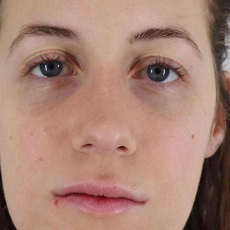 Rhinoplasty/Nose Reshaping Before & After Gallery - Patient 87551747 - Image 4