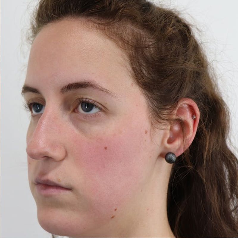 Rhinoplasty/Nose Reshaping Before & After Gallery - Patient 87551747 - Image 5