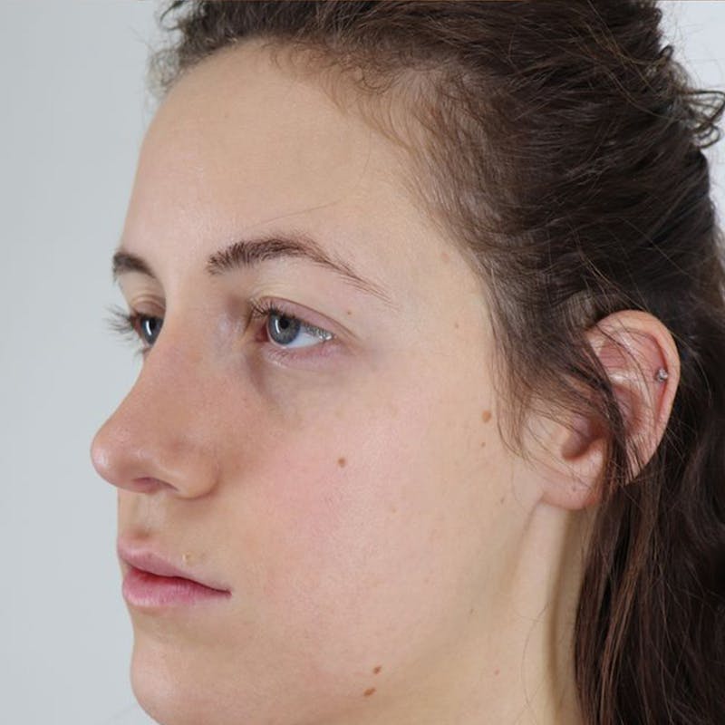 Rhinoplasty/Nose Reshaping Before & After Gallery - Patient 87551747 - Image 6