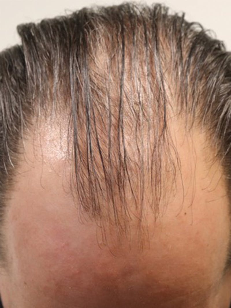 Neograft Before & After Gallery - Patient 87551769 - Image 1