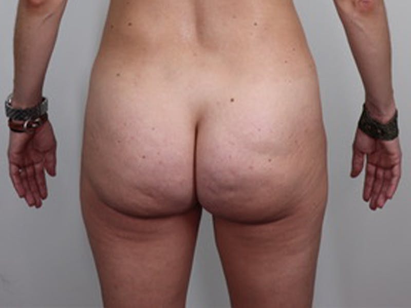 Brazilian Butt Lift Before & After Gallery - Patient 87551776 - Image 1