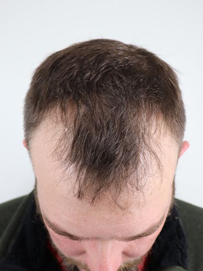 Hair Restoration Before & After Gallery - Patient 87551774 - Image 1